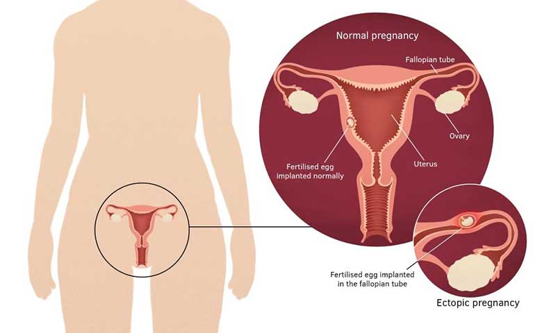 Understanding the Symptoms of Ectopic Pregnancy